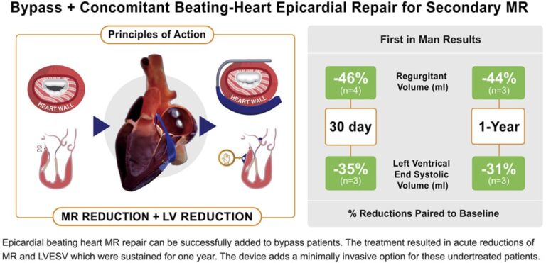 Bypass + Concomitant Beating-Heart Epicardial Repair for Secondary MR